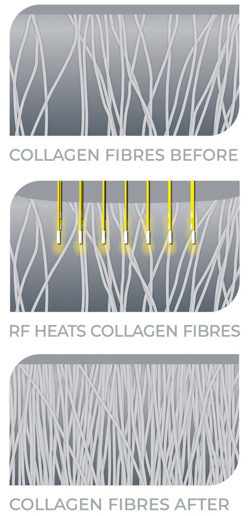MAR-DMF-COLB.A-REV01_DMF-collagen-before-and-after-diagram-2021