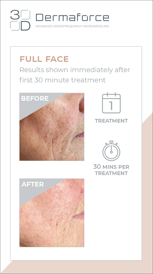 MAR-DMF-FFRES1-INSTAST-REV01_dmf-stories-ful-face-results-1