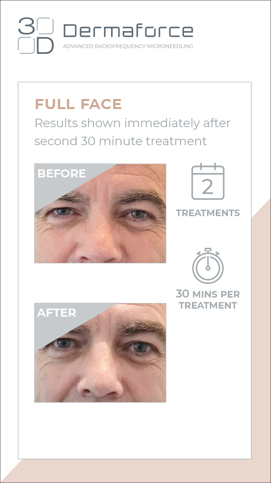 MAR-DMF-FFRES2-INSTAST-REV01_dmf-stories-ful-face-results-2