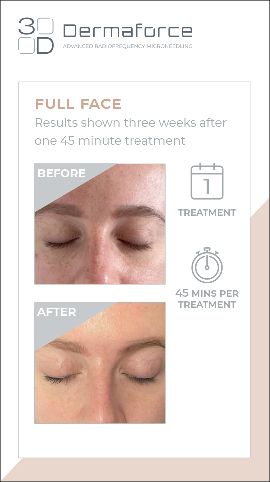 MAR-DMF-FFRES3-INSTAST-REV01_dmf-stories-ful-face-results-3